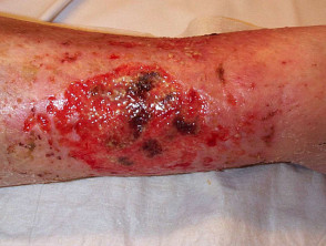 Úlcera de pierna