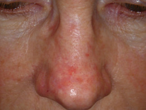 Queratosis actínicas que afectan la cara
