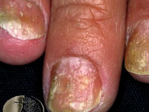 nagel psoriasis