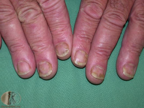 nagel psoriasis