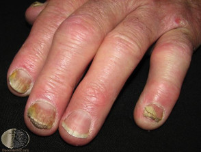 nagel psoriasis