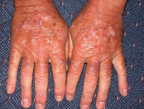 Queratosis actínicas que afectan a las manos