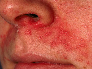 Dermatitis perioral