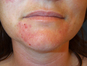 Dermatitis perioral