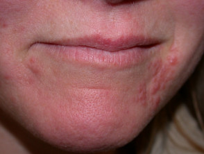 periorale dermatitis