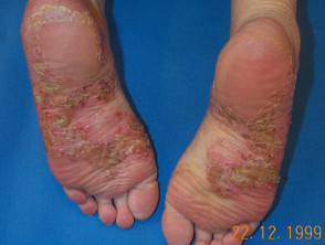 Psoriasis pustulosa de las manos y tarifa