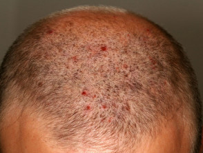 Foliculitis del cuero cabelludo