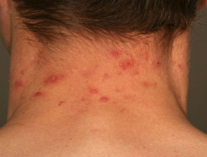 hoofdhuid folliculitis