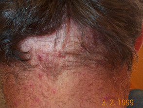 hoofdhuid folliculitis