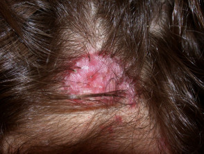 hoofdhuid folliculitis