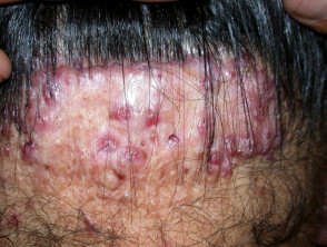 Foliculitis del cuero cabelludo