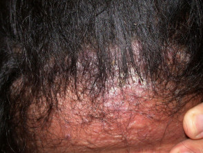 Foliculitis del cuero cabelludo