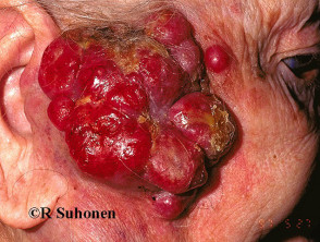 Carcinoma de células escamosas en la cara.