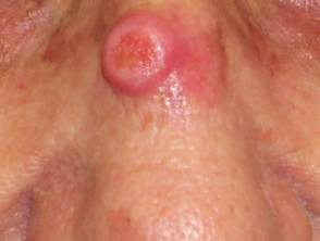 Carcinoma de células escamosas en la cara.