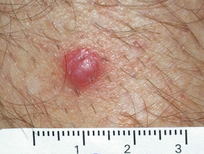 Carcinoma de células escamosas de extremidades