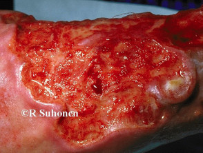 Carcinoma de células escamosas de extremidades