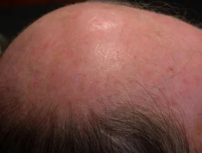 Queratosis actínicas que afectan al cuero cabelludo