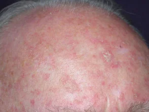 Queratosis actínicas que afectan al cuero cabelludo