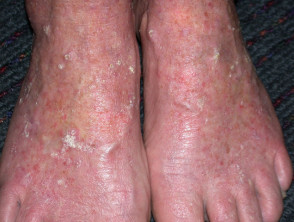 Queratosis actínicas que afectan a piernas y pies 