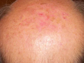 Queratosis actínicas que afectan al cuero cabelludo