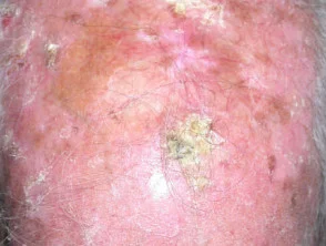 Queratosis actínicas que afectan al cuero cabelludo