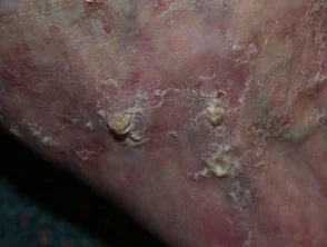 Queratosis actínicas que afectan a piernas y pies 