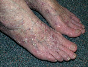 Queratosis actínicas que afectan a piernas y pies