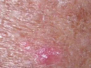 Queratosis actínicas que afectan las piernas y los pies