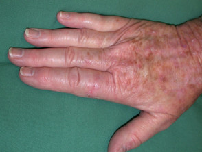Queratosis actínicas que afectan a las manos.