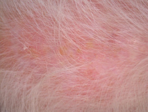 Queratosis actínicas que afectan al cuero cabelludo