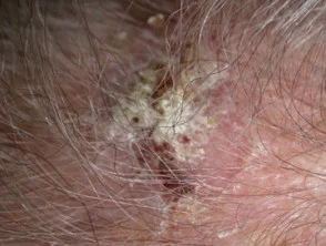 Queratosis actínicas que afectan al cuero cabelludo