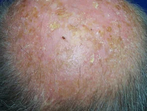 Queratosis actínicas que afectan al cuero cabelludo