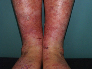 Queratosis actínicas que afectan a piernas y pies 