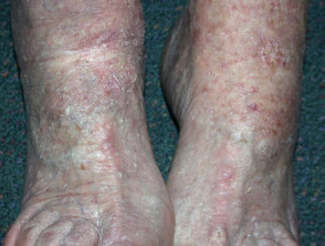 Queratosis actínicas que afectan las piernas y los pies