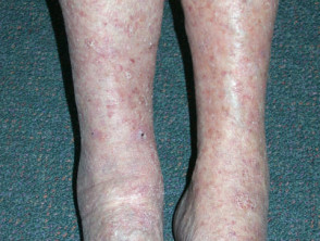 Queratosis actínicas que afectan las piernas y los pies