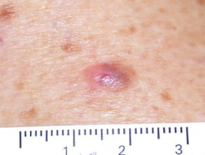 Nevus atípico