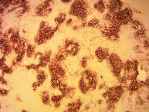 Inmunohistoquímica del linfoma angioinmunoblástico de células T