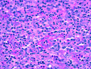 Histología del linfoma angioinmunoblástico de células T