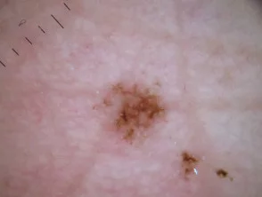 Akrale linsenförmige Melanomdermoskopie