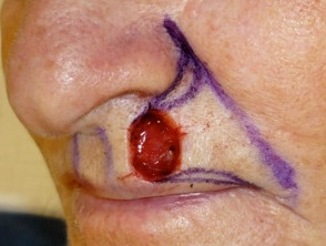 Herida por escisión marcada para la reparación del colgajo de avance
