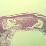 angiokeratoma-pathology-figure-1__protectwyjqcm90zwn0il0_focusfillwzi5ncwymjisinkildzd-9776509-6452555-jpg-1207547