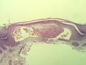 Angiokeratoom pathologie