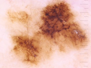 Líneas anguladas observadas en la dermatoscopia de un melanoma