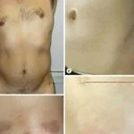 annular-lichenoid-dermatitis-fig-1-macroscopic-features__protectwyjqcm90zwn0il0_focusfillwzi5ncwymjisinkildm4xq-7643782-5299097-jpeg-6929225