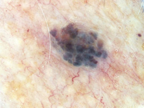 Dermatoscopia angioma cereza azul