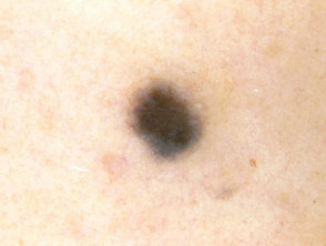 Nevus azul, tipo de piel 3, dermatoscopia 2