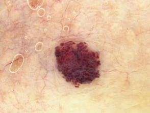 Dermatoscopia de angioma de cereza