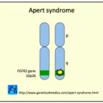 crouzon-syndrome2__protectwyjqcm90zwn0il0_focusfillwzi5ncwymjisingildfd-5932373-6480652-png-4206073