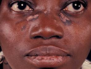 Hipopigmentación e hiperpigmentación en pieles negras
