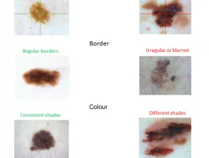 Regola clinica ABCD del melanoma